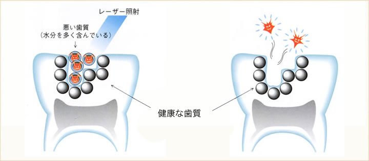 虫歯のレーザー治療