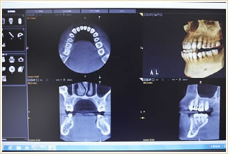 歯科用　３DCT