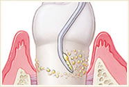 歯周病・歯周内科