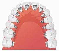 裏側矯正（舌側矯正）
