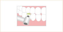 歯のクリーニング