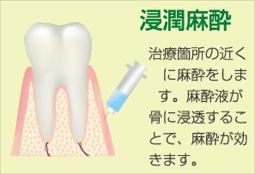 麻酔 食事 歯医者 後 虫歯治療後の食事で知っておくべき注意点